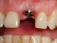 Dental Implants 6155, Dentist Canning Vale