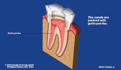 Root Canal Therapy Canning Vale 6155