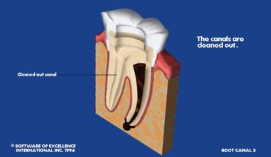 Root Canal Therapy Canning Vale 6155
